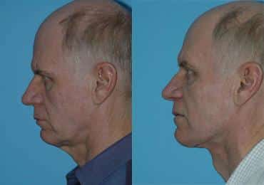 Before and after Submentoplasty by Dr. Shervin Naderi, Patient 8939