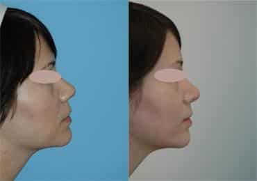 Before and after Rhinoplasty by Dr. Shervin Naderi, Patient 8855