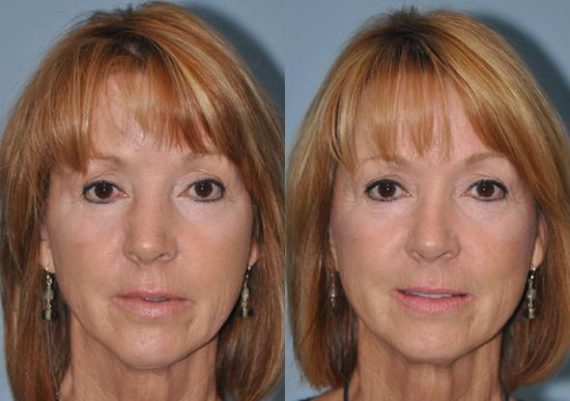 Before and after Rhinoplasty by Dr. Shervin Naderi, Patient 8856