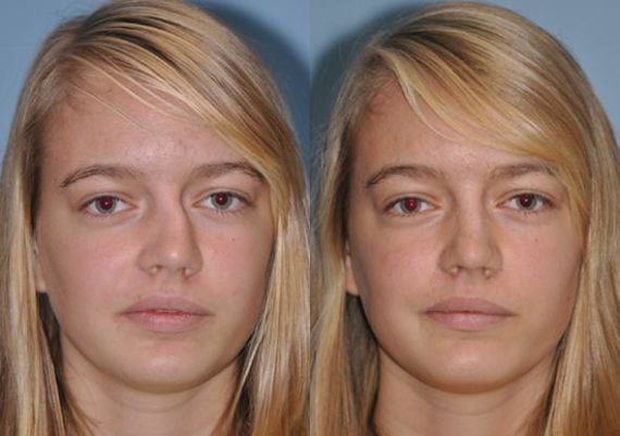 Before and after Rhinoplasty by Dr. Shervin Naderi, Patient 8857