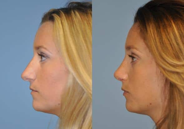 Before and after Rhinoplasty by Dr. Shervin Naderi, Patient 8858