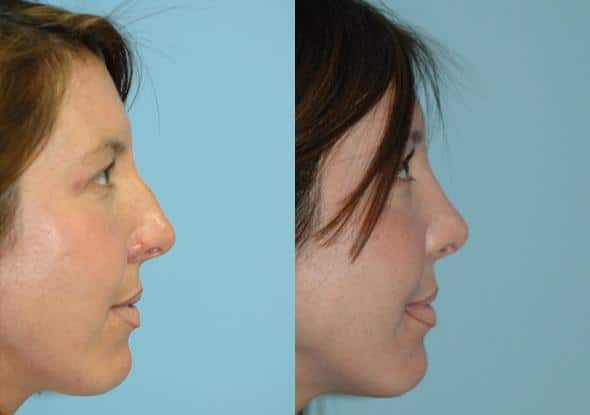 Before and after Rhinoplasty by Dr. Shervin Naderi, Patient 8859