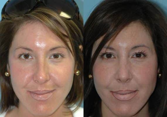 Before and after Rhinoplasty by Dr. Shervin Naderi, Patient 8859