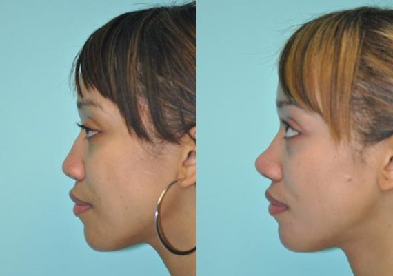 Before and after Rhinoplasty by Dr. Shervin Naderi, Patient 8860