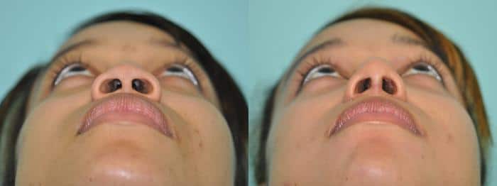 Before and after Rhinoplasty by Dr. Shervin Naderi, Patient 8860