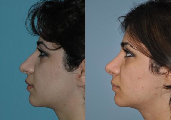 Before and after Rhinoplasty by Dr. Shervin Naderi, Patient 8861