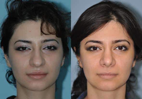 Before and after Rhinoplasty by Dr. Shervin Naderi, Patient 8861