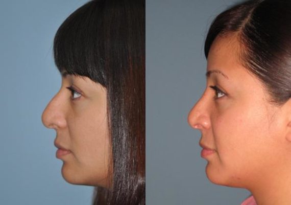 Before and after Rhinoplasty by Dr. Shervin Naderi, Patient 8862