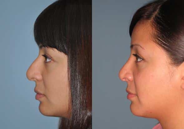 Before and after Rhinoplasty by Dr. Shervin Naderi, Patient 8862