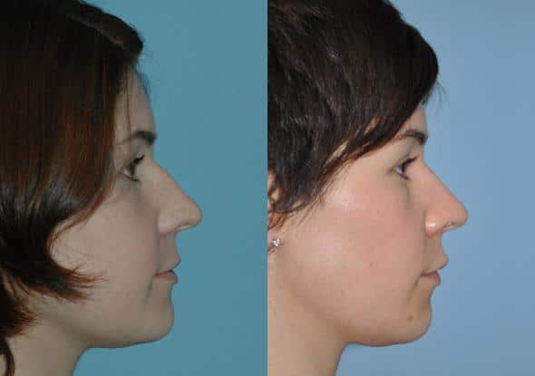 Before and after Rhinoplasty by Dr. Shervin Naderi, Patient 8863