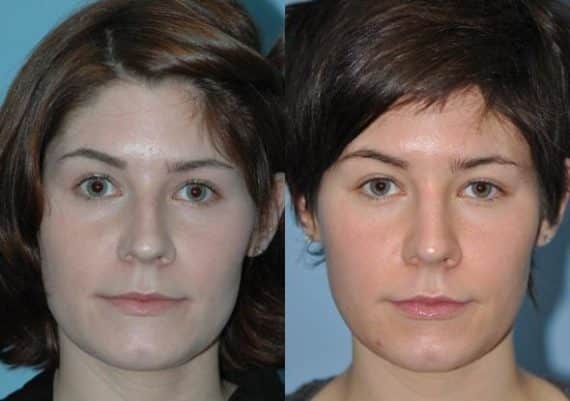 Before and after Rhinoplasty by Dr. Shervin Naderi, Patient 8863