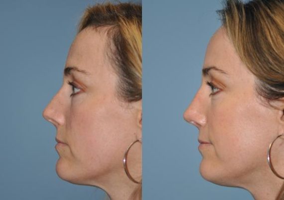 Before and after Rhinoplasty by Dr. Shervin Naderi, Patient 8864