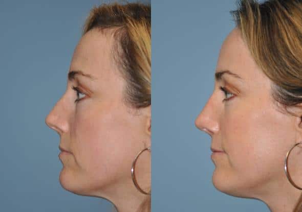 Patient 8864, Rhinoplasty Before and After Photos Before and after Rhinoplasty by Dr. Shervin Naderi, Patient 8864