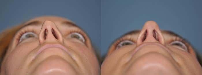 Patient 8864, Rhinoplasty Before and After Photos Before and after Rhinoplasty by Dr. Shervin Naderi, Patient 8864