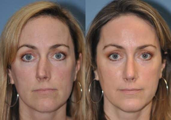 Before and after Rhinoplasty by Dr. Shervin Naderi, Patient 8864