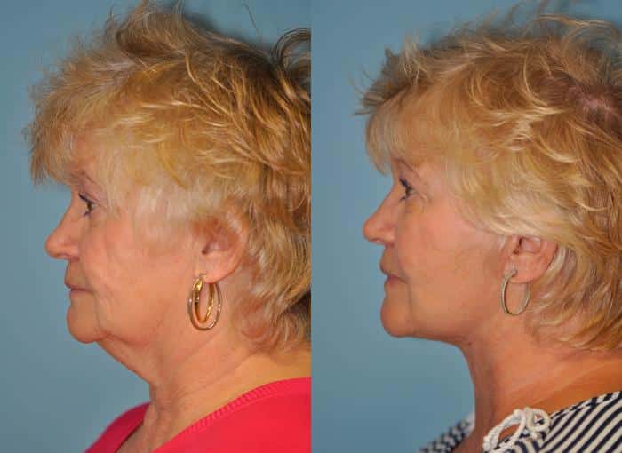 Before and after Facelift by Dr. Shervin Naderi, Patient 8900