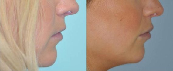 Before and after Lip Implant by Dr. Shervin Naderi, Patient 8936