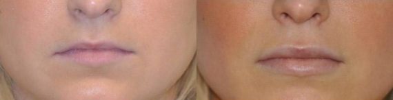 Before and after Lip Implant by Dr. Shervin Naderi, Patient 8936