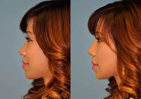 Before and after Non-Surgical Rhinoplasty by Dr. Shervin Naderi, Patient 8915