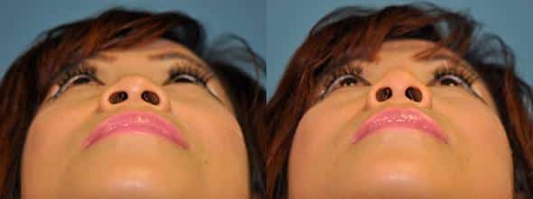 Before and after Non-Surgical Rhinoplasty by Dr. Shervin Naderi, Patient 8915