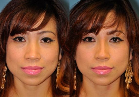 Before and after Non-Surgical Rhinoplasty by Dr. Shervin Naderi, Patient 8915