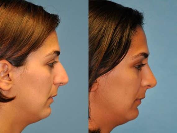 Before and after Rhinoplasty by Dr. Shervin Naderi, Patient 8837