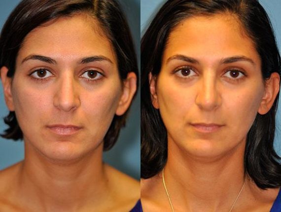 Before and after Rhinoplasty by Dr. Shervin Naderi, Patient 8837