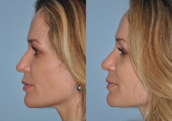 Before and after Rhinoplasty by Dr. Shervin Naderi, Patient 8865