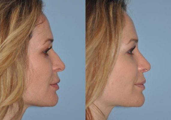 Before and after Rhinoplasty by Dr. Shervin Naderi, Patient 8865