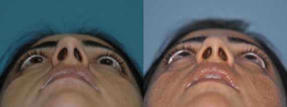 Before and after Rhinoplasty by Dr. Shervin Naderi, Patient 8866