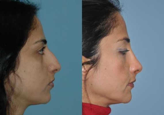 Before and after Rhinoplasty by Dr. Shervin Naderi, Patient 8866