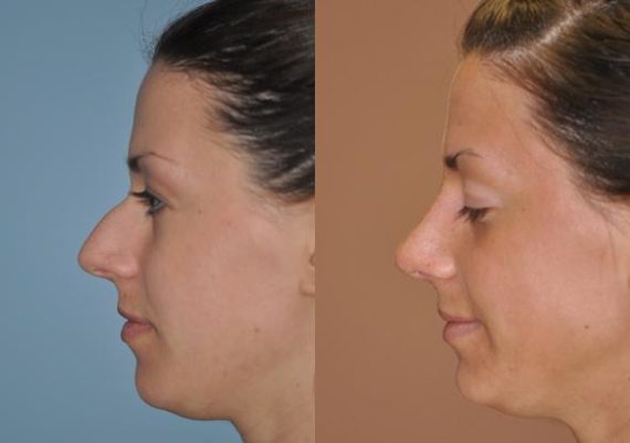 Before and after Rhinoplasty by Dr. Shervin Naderi, Patient 8867