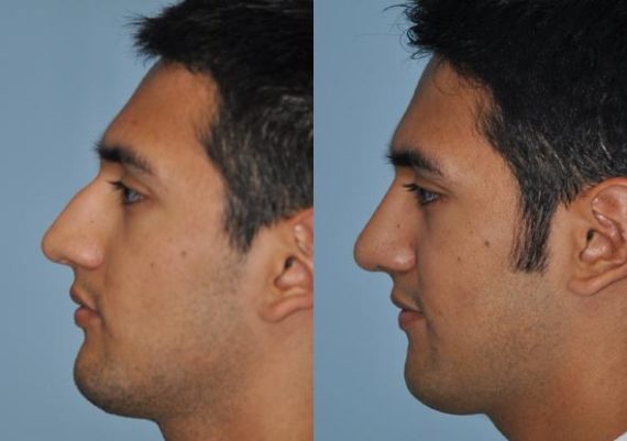 Before and after Rhinoplasty by Dr. Shervin Naderi, Patient 8868