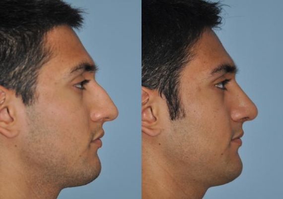 Before and after Rhinoplasty by Dr. Shervin Naderi, Patient 8868