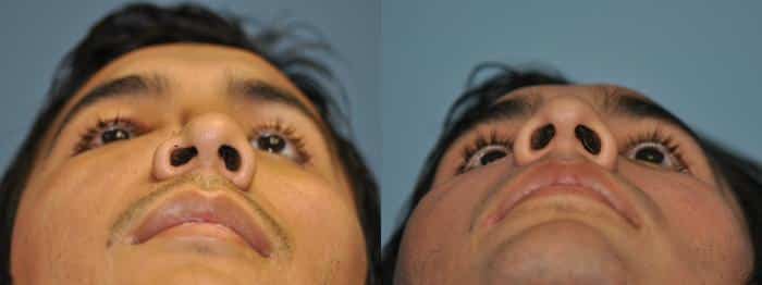 Before and after Rhinoplasty by Dr. Shervin Naderi, Patient 8870