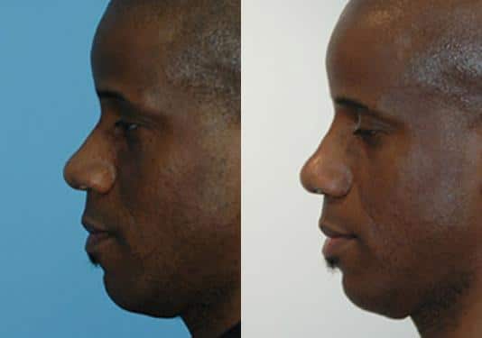 Before and after Rhinoplasty by Dr. Shervin Naderi, Patient 8871