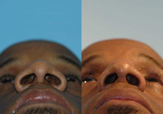 Before and after Rhinoplasty by Dr. Shervin Naderi, Patient 8871