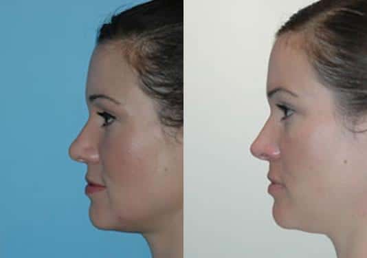 Before and after Rhinoplasty by Dr. Shervin Naderi, Patient 8872