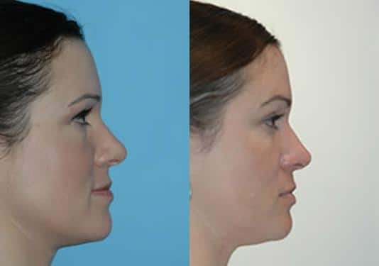 Before and after Rhinoplasty by Dr. Shervin Naderi, Patient 8872