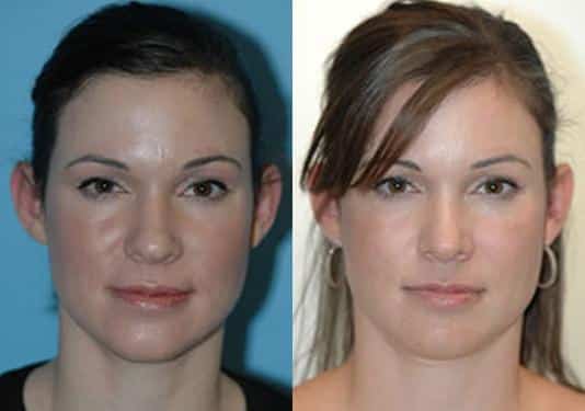 Before and after Rhinoplasty by Dr. Shervin Naderi, Patient 8872