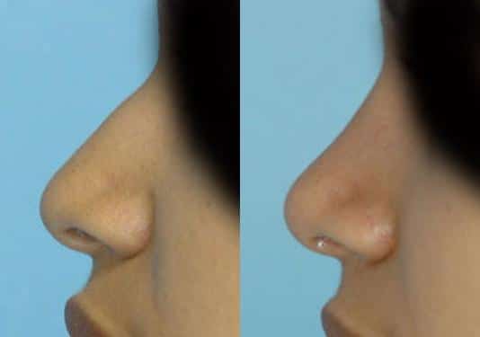 Before and after Rhinoplasty by Dr. Shervin Naderi, Patient 8873