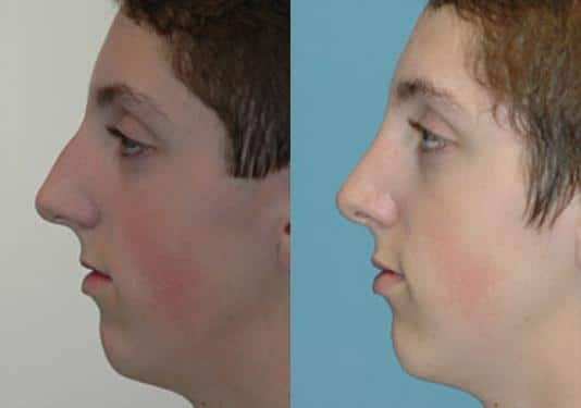 Before and after Rhinoplasty by Dr. Shervin Naderi, Patient 8874