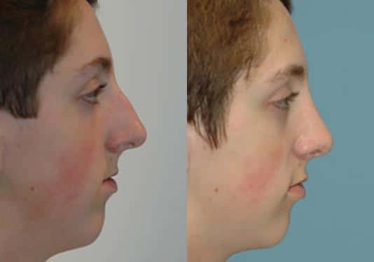 Before and after Rhinoplasty by Dr. Shervin Naderi, Patient 8874