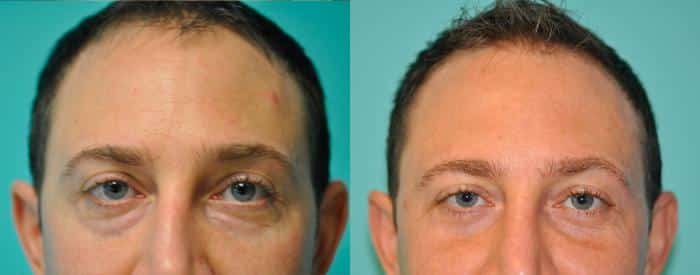 Before and after Blepharoplasty by Dr. Shervin Naderi, Patient 8920