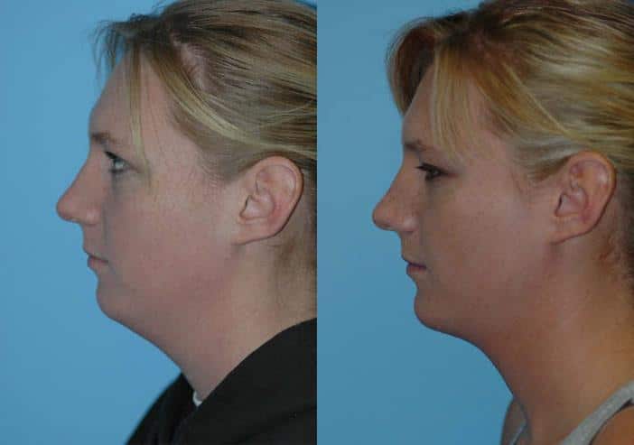 Before and after Chin & Facial Implant by Dr. Shervin Naderi, Patient 8930