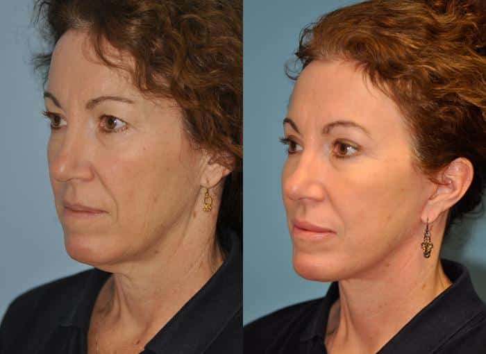 Before and after Facelift by Dr. Shervin Naderi, Patient 8902