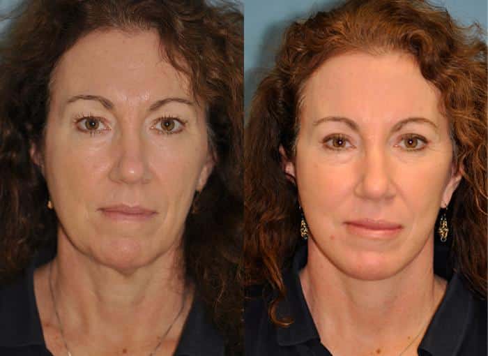 Before and after Facelift by Dr. Shervin Naderi, Patient 8902