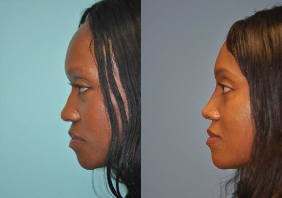 Before and after Non-Surgical Rhinoplasty by Dr. Shervin Naderi, Patient 8913