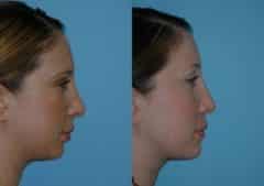 Before and after Revision Rhinoplasty by Dr. Shervin Naderi, Patient 8890