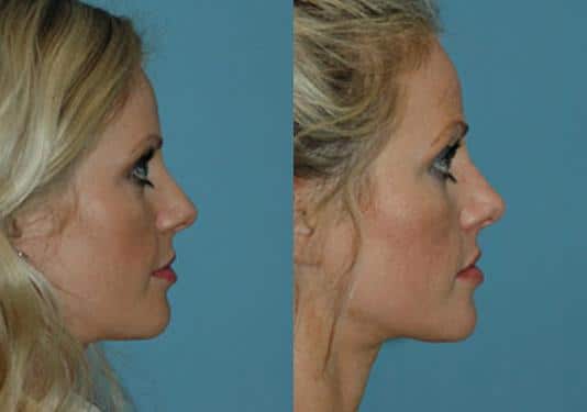 Patient 8875, Rhinoplasty Before and After Photos Before and after Rhinoplasty by Dr. Shervin Naderi, Patient 8875